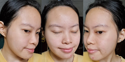 Hasil pemakaian Avoskin Miraculous Acne Solution Micro Serum