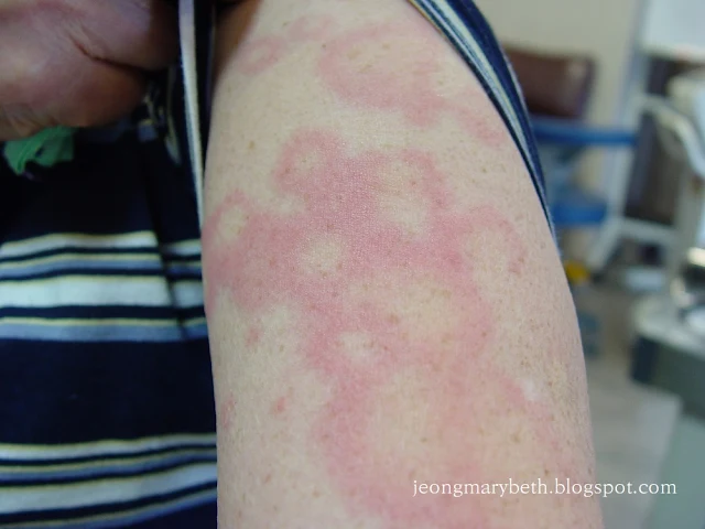 Erythema annulare centrifugum image