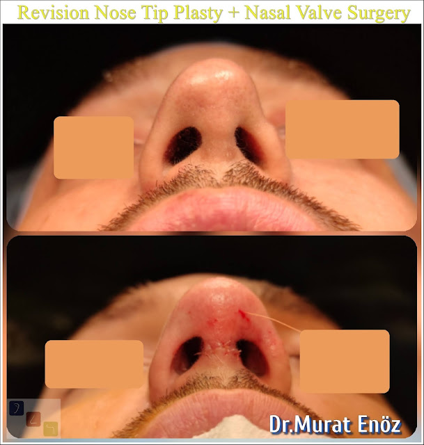 Revision Nose Tip Plasty + Nasal Valve Surgery