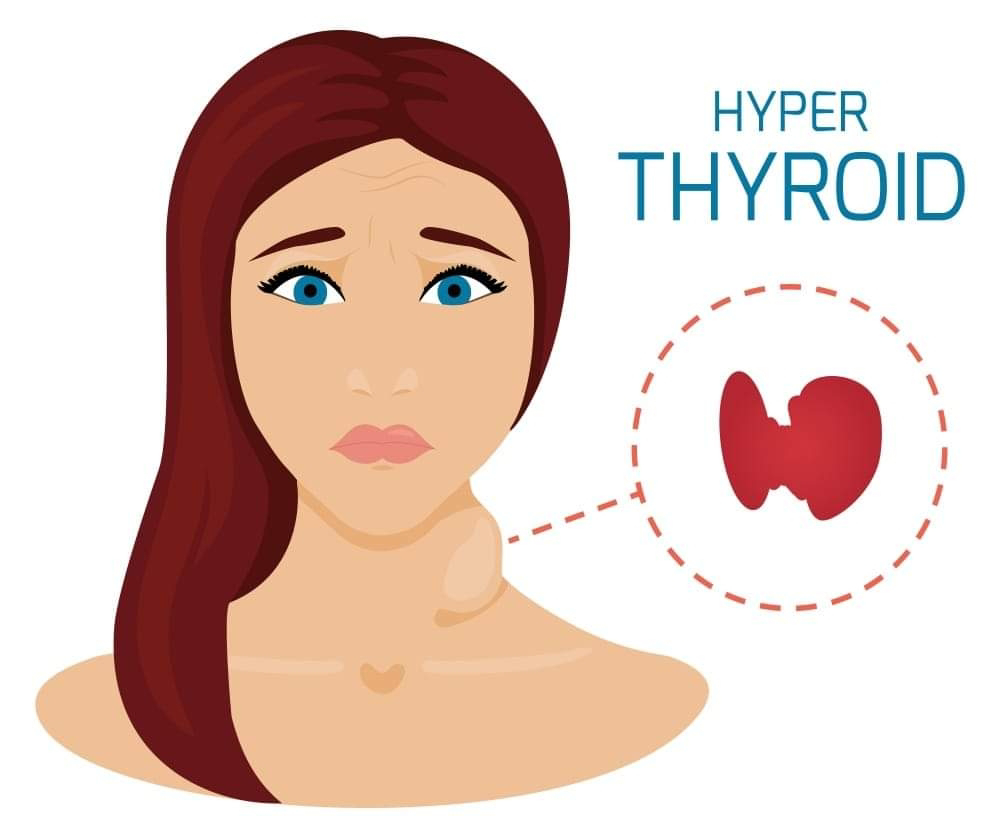 Ubat carbimazole dan hyperthyroid.