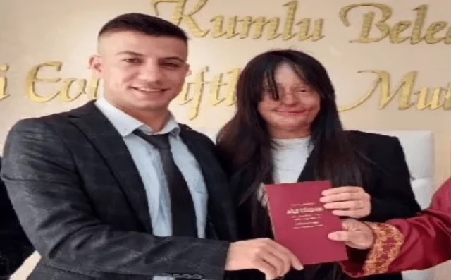Sposa la persona che le ha gettato dell'acido sul volto  Kasim Ozan Celtic e Berfin Ozek nel giorno del matrimonio