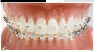 Phương pháp niềng răng kim loại bao nhiêu tiền
