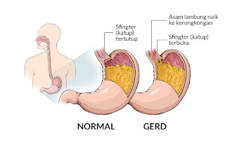 dr. Reinita Arlin: Tips Redakan Asam Lambung