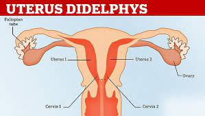Uterus Didelphys, Dua Vagina dan Dua Rahim?