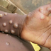 Amazonas teve 33 casos de mpox em 2025