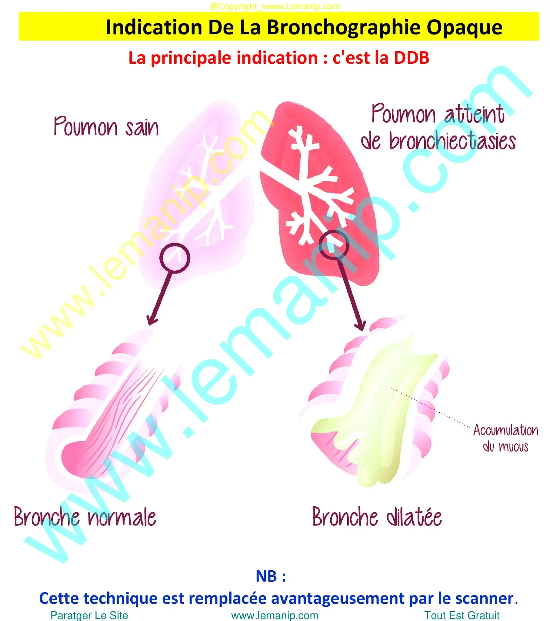 bronchoalveolar ca,lung lavage for copd,whole lung lavage,lung lavage,opdivo lung,restrictive airway disease,small airway disease,inflated lungs,hyperexpanded lungs,enlarged lungs