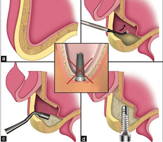 Trồng răng implant có nguy hiểm không-2