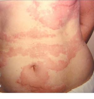 Top 6 Questions Asked About Urticaria in 2021