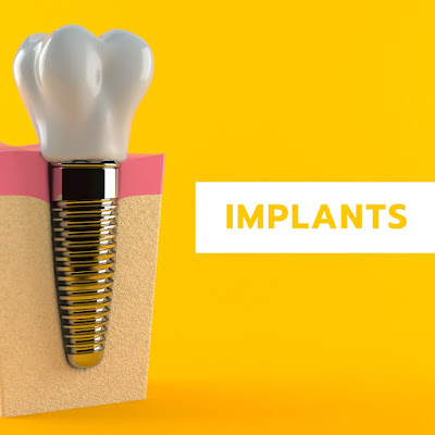 dental implants burlington