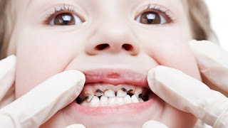 Quy trình trám răng tại nha khoa-2