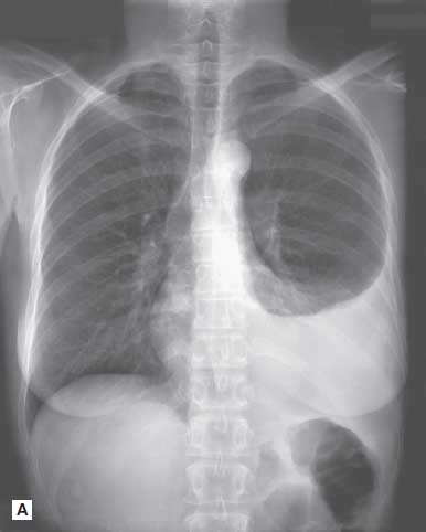 Posteroanterior film of the chest