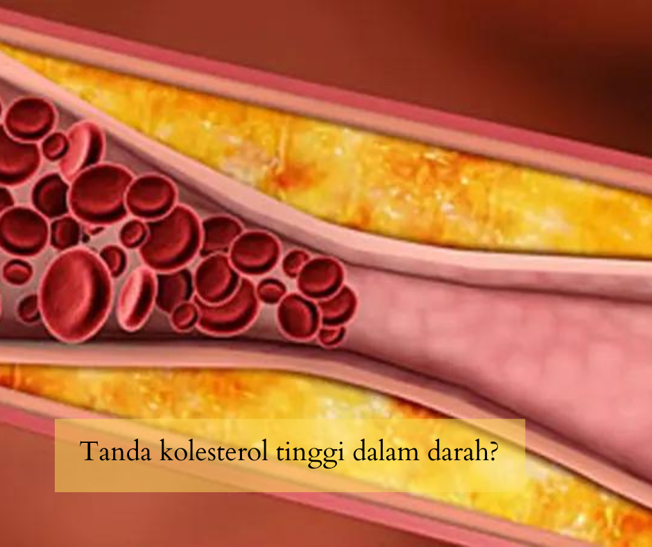 Tanda kolesterol tinggi dalam darah?