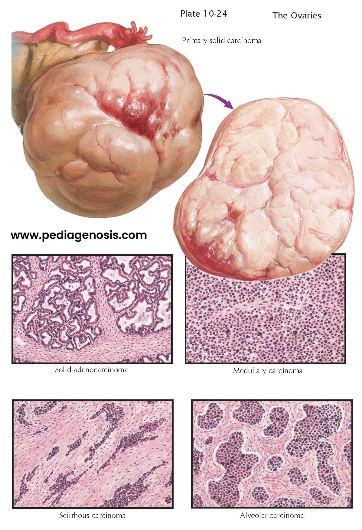 PRIMARY SOLID CARCINOMA