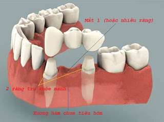 Quy trình làm cầu răng sứ chuẩn-2