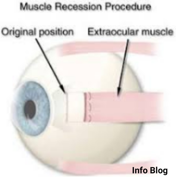 Strabismus surgery