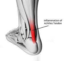Achilles Tendon