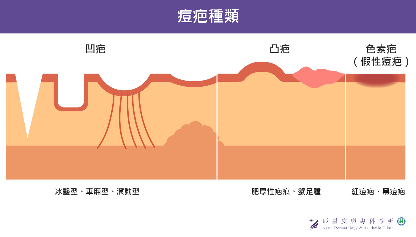 痘疤種類