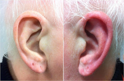 Если ваши мочки ушей ярко -красные и "горят', возможно, у вас синдром красного уха (RES).