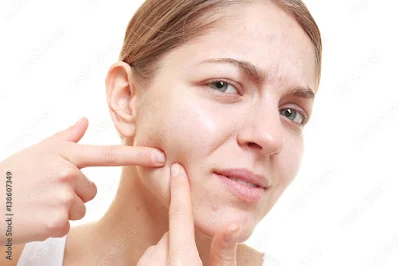 1. मुँहासा मुखौटा (Acne mask)