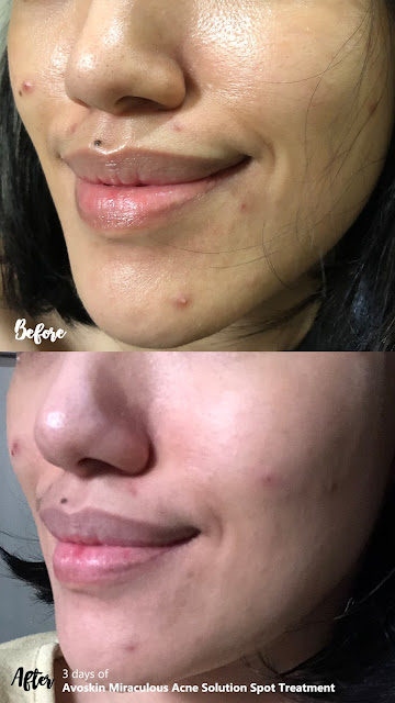 Before After Avoskin Miraculous Acne Solution Spot Treatment