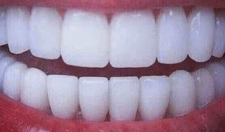 White Teeth Aren't So Healthy As You Think#