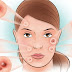 Acne - Symptoms and causes