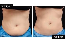 What is CoolSculpting?_ichhori.com