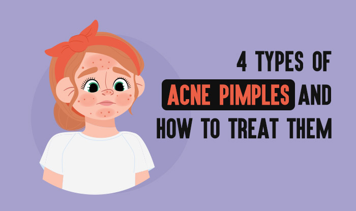 4 Types of Acne Pimples and How to Treat Them