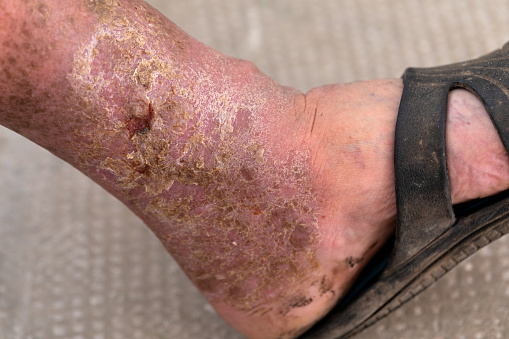 How to Prevent Foot Ulcers in Diabetes