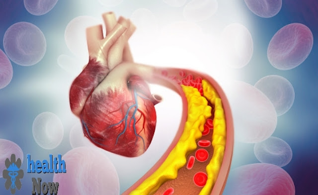 Treatment herosclerotic vascular