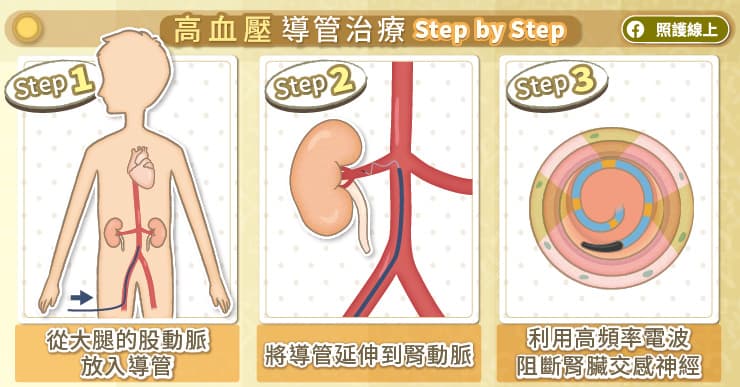 高血壓導管治療步驟圖解