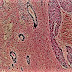 Growth delay in necrotic tumors by Enzyme/prodrug therapy 