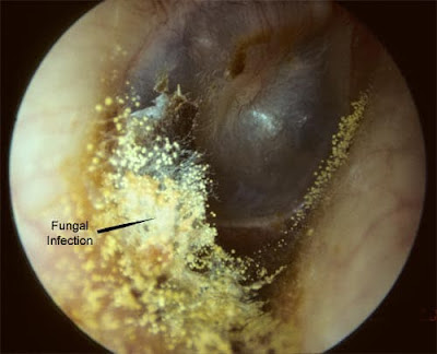 شكل فطريات الأذن في القناة السمعية