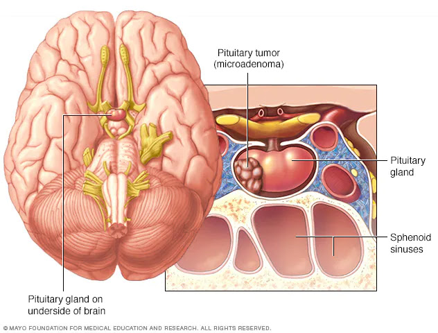 Signs and symptoms of Pituitary adenoma