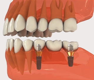 Các loại cầu răng sứ phổ biến-1