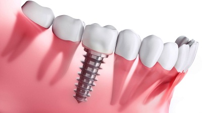 best dental implants in dubai and abu dhabi