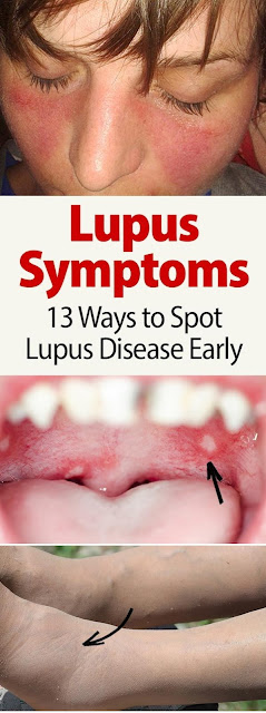 Lupus Symptoms: 13 Ways To Spot Lupus Disease Early