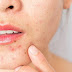 What is Avoiding Adult Acne?  - SEO Expert In Jaranwala