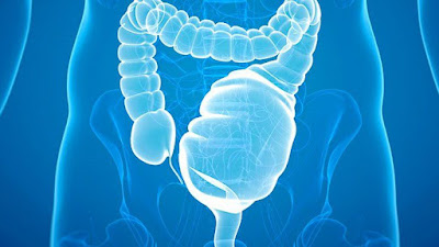 Ulcerative colitis, the most common type of inflammatory bowel disease, affects the colon (large intestine lining) and rectum.