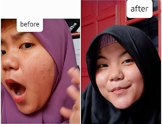 Before After Treatment