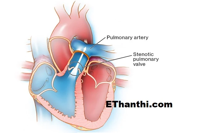 இதயத்தில் பல்மனரி வால்வு அடைப்பு ஏற்பட்டால் என்னவாகும்?