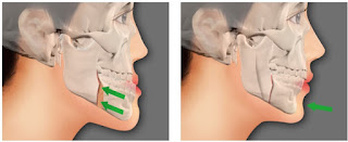 Quy trình thực hiện hàm hô móm -2