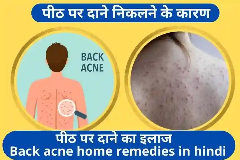 back acne home remedies in hindi