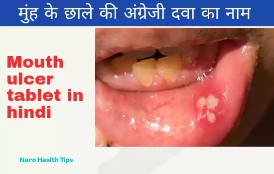 मुंह के छाले की अंग्रेजी दवा का नाम | Mouth Ulcer Tablet or medicine In Hindi