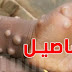 الجدري يكتسح العالم: ماهو هذا المرض وطرق العدوى والوقاية منه؟