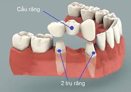 Quy trình làm cầu răng sứ tại nha khoa-2