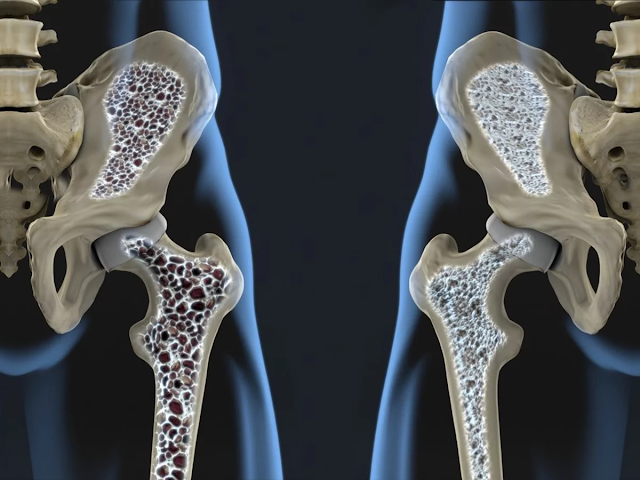 3 Jenis Osteoporosis