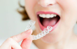 Quy trình niềng răng invisalign-2