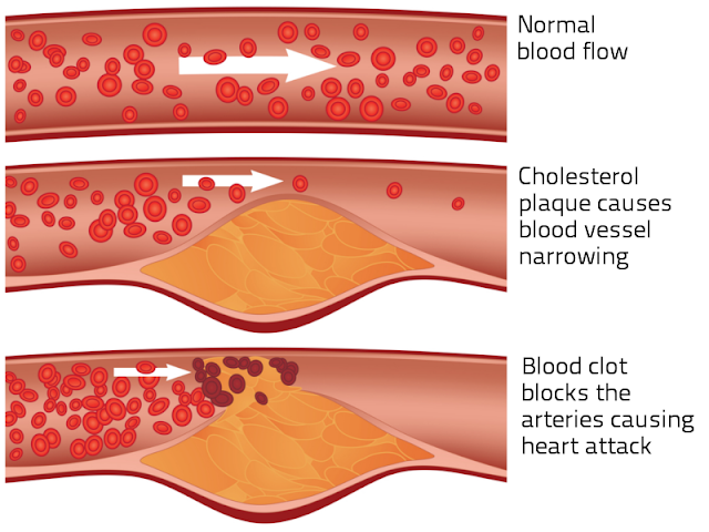 Bad cholesterol - Karrel Hamutenya Updated World