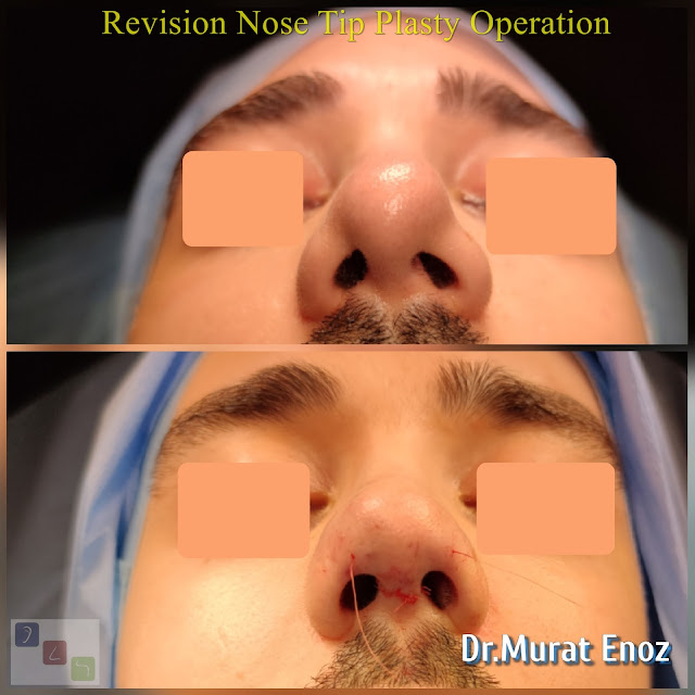 Revision Aesthetic Nose Tip Surgery,Revision Nose Tip Plasty in Istanbul,